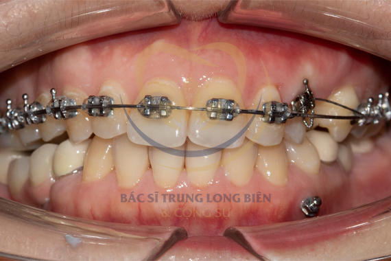 Cắm Minivis trong chỉnh nha - Cắm Vis có đau không - Lợi ích?