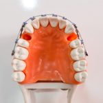Nhổ răng số 8 khi niềng răng: khi nào cần và vì sao