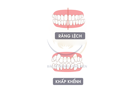 Sai khớp cắn - Top những kiểu hình sai khớp cắn thường gặp!
