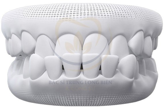 Khớp cắn ngược - Chỉnh nha sẽ giúp cải thiện như thế nào?