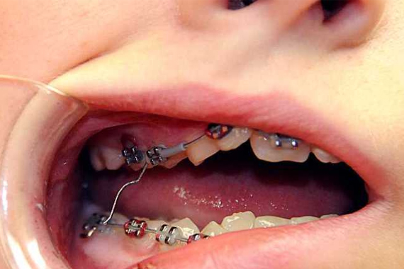Dây cung chọc má - Niềng răng mắc cài và những vấn đề bất cập!