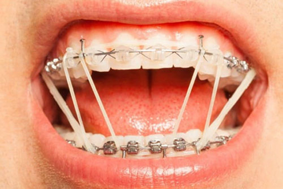 Kéo răng chỉnh nha - Quy tắc chuẩn chỉnh trong chỉnh nha!