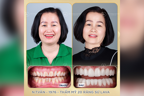 Làm răng sứ thẩm mỹ có khiến răng thật bị yếu đi không? - Nha khoa Bác sĩ Trung Long Biên