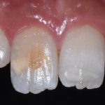 Đốm trắng trên răng là gì? Nguyên nhân và cách xử lý