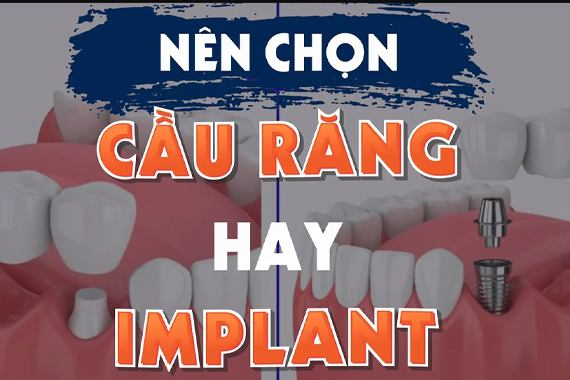 Tình trạng mất răng - Nên trồng Implant hay làm cầu răng?