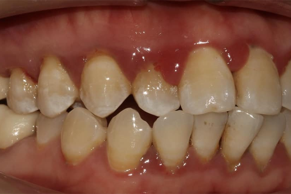 Tình trạng viêm lợi - Làm thế nào để điều trị dứt điểm tình trạng này