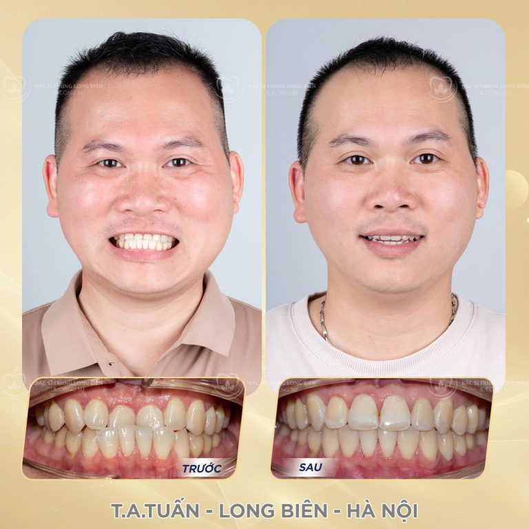 Niềng răng chỉnh khớp cắn ‑ ảnh trước và sau điều trị tại Nha khoa Bác sĩ Trung Long Biên