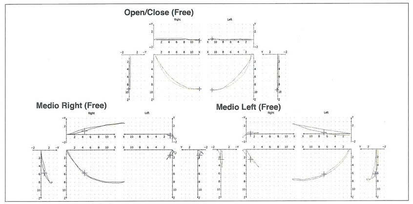 Bản ghi lồi cầu đồ vận động open close và sang bên - chỉ định đo lồi cầu đồ