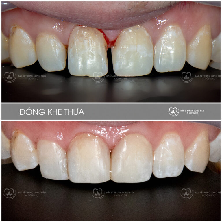 Ảnh trước và sau thẩm mỹ răng ‑ đóng khe thưa tại Nha khoa Bác sĩ Trung Long Biên