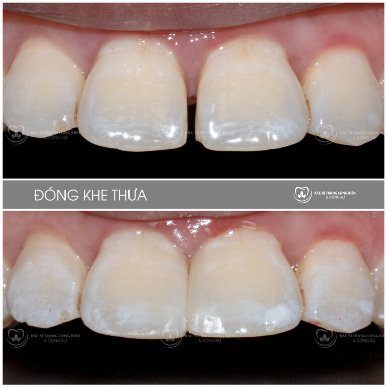 Đóng khe thưa răng cửa ‑ ảnh trước và sau điều trị tại Nha khoa Bác sĩ Trung Long Biên