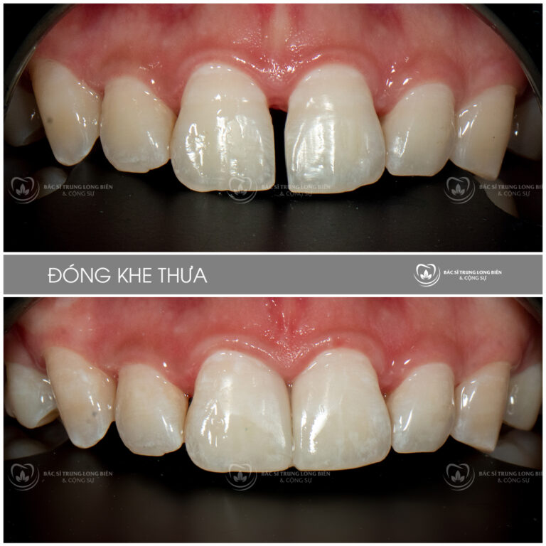 Đóng khe thưa răng cửa giữa ‑ ảnh trước và sau điều trị tại Nha khoa Bác sĩ Trung Long Biên
