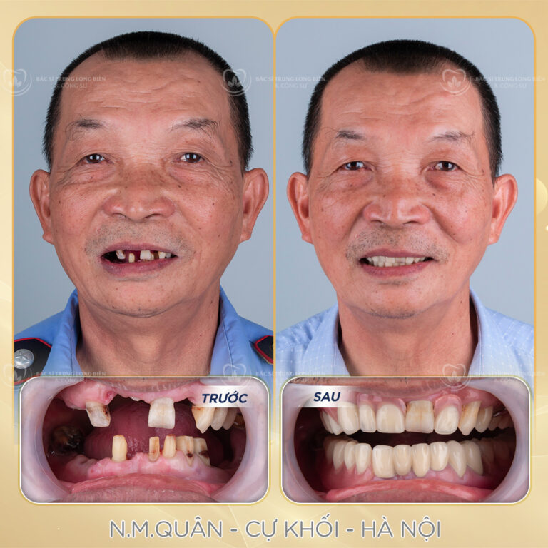 Ảnh trước và sau phục hình răng mất ‑ hàm tháo lắp tại Nha khoa Bác sĩ Trung Long Biên