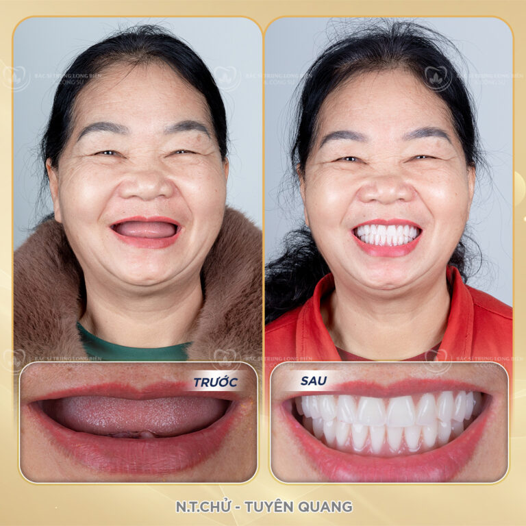 Hàm tháo lắp toàn hàm ‑ ảnh trước và sau điều trị tại Nha khoa Bác sĩ Trung Long Biên