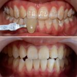Xóa đốm trắng trên răng bằng công nghệ ICON, không cần mài răng