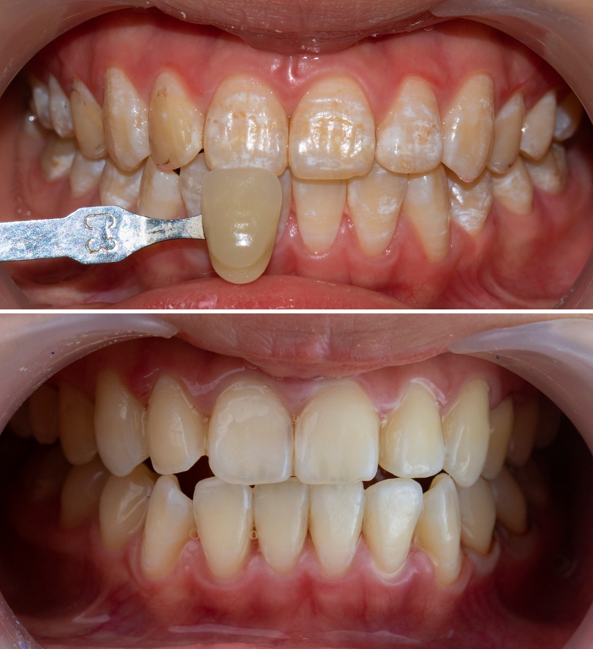 Trước và sau khi xóa đốm trắng trên răng bằng công nghệ ICON tại Nha khoa Bác sĩ Trung Long Biên