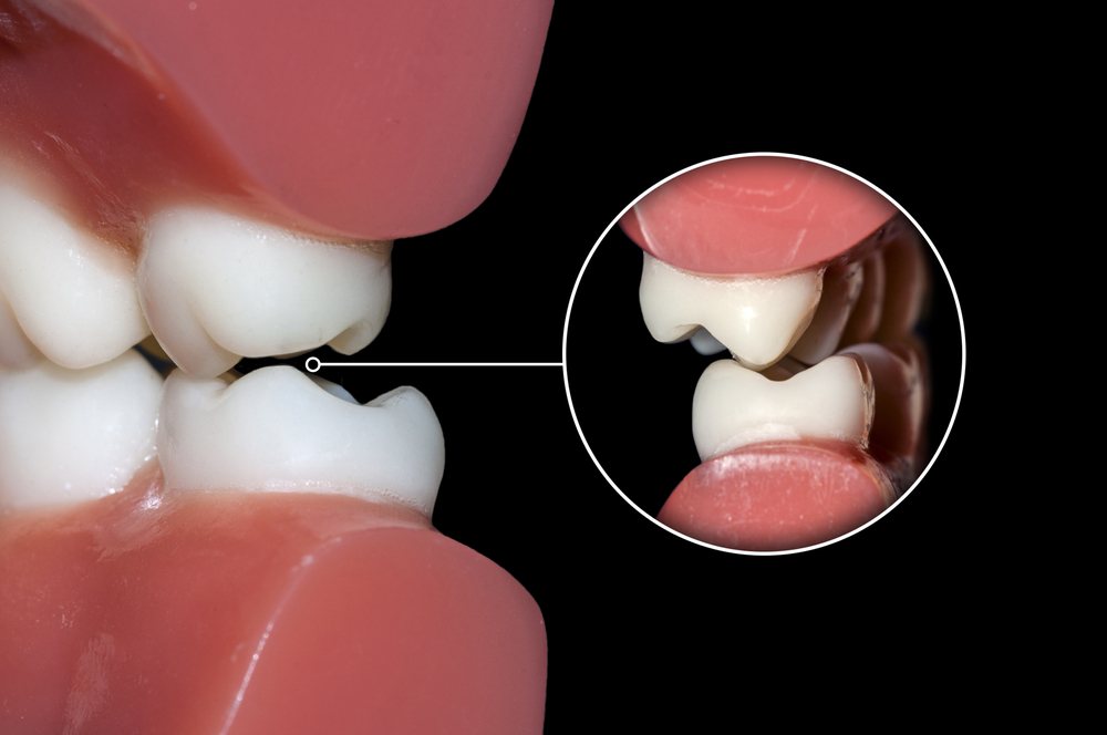 Mô hình khớp cắn giữa răng hàm trên và hàm dưới - Nha khoa Bác sĩ Trung Long Biên
