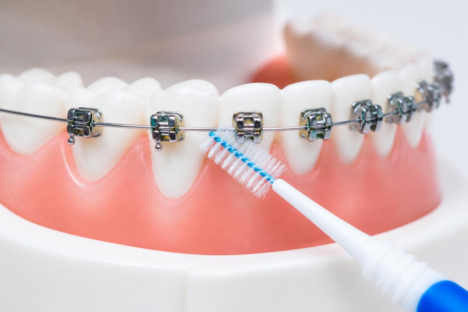 Bàn chải kẽ làm sạch quanh mắc cài trên mô hình hàm, phòng bệnh lý răng khi đeo mắc cài - ảnh minh hoạ