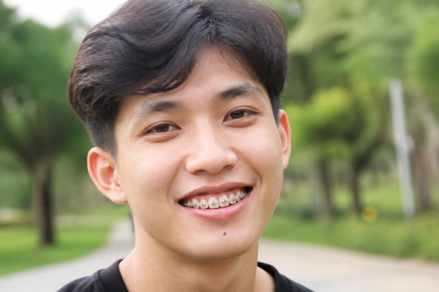 Chàng trai đang niềng răng mắc cài cười tươi ngoài công viên - ảnh minh hoạ phương pháp điều trị khớp cắn hở