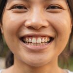 Đốm trắng trên răng là gì? Nguyên nhân và cách xử lý