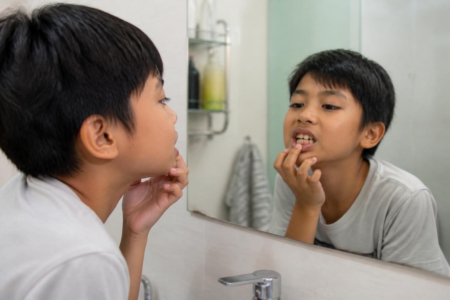 Bé trai soi gương xem răng, phát hiện biểu hiện khớp cắn chéo - ảnh minh hoạ